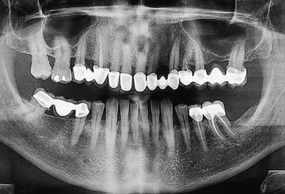 digital x-rays showing a patient's teeth